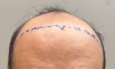 Antes: região frontal com perda capilar e a marcação da linha planejada