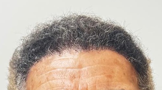 Depois: a mesma região frontal após o transplante capilar
