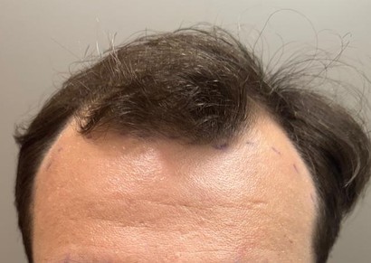 Antes: entradas e linha frontal recuadas