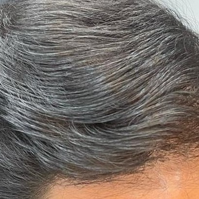 Depois: o cabelo do mesmo paciente após o tratamento, visto de lado